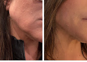 Side-by-side photographs of a client’s lower cheek and jaw area.