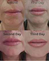 Four-stage close-up sequence of a client’s lips.